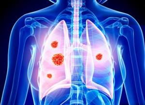 Καρκίνος πνευμόνων