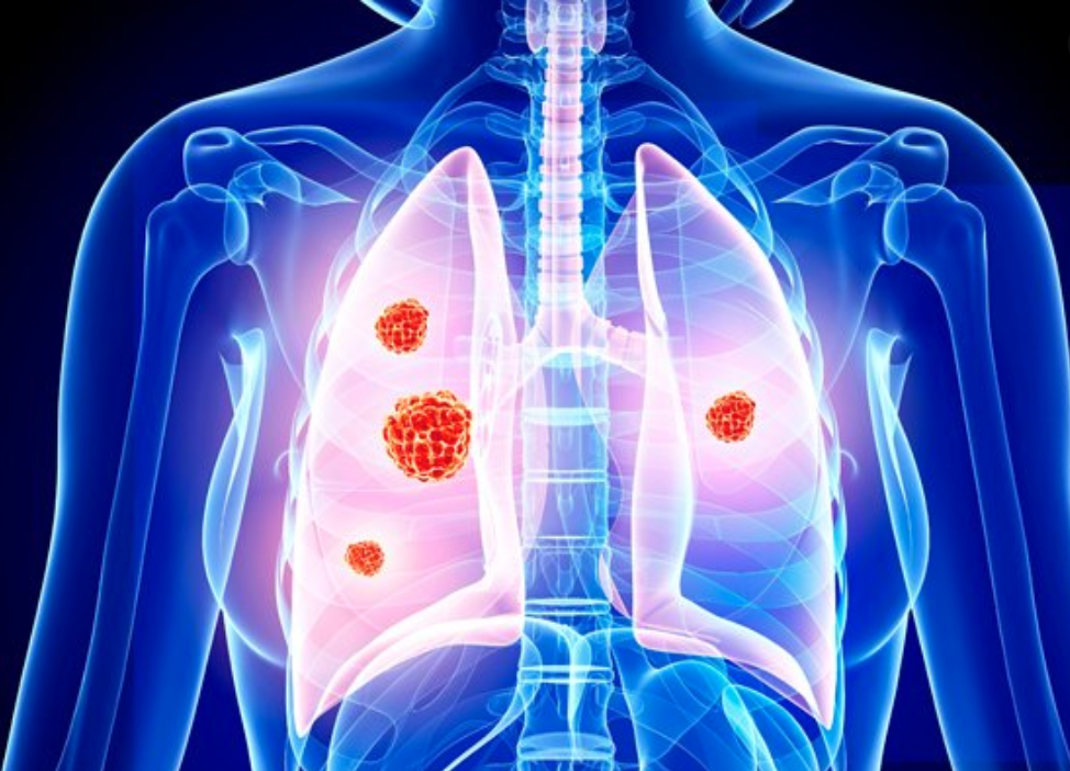 Καρκίνος πνευμόνων