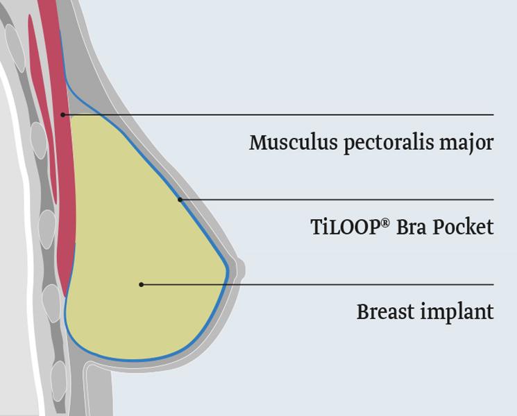 TiLOOP-Bra_Pocket_Lage_EN